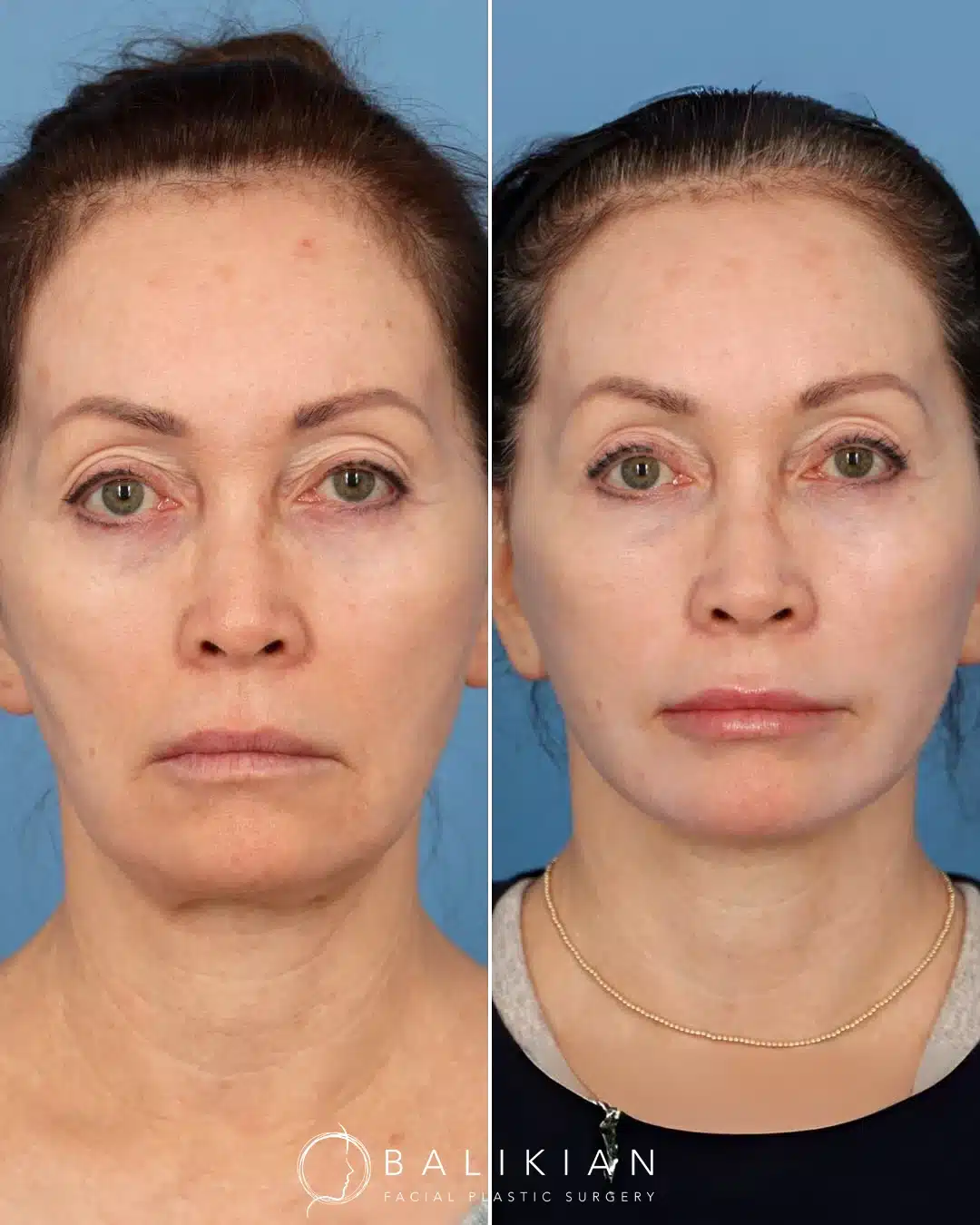 Front view before and after facelift and neck lift showing tighter jawline and refreshed lower face.