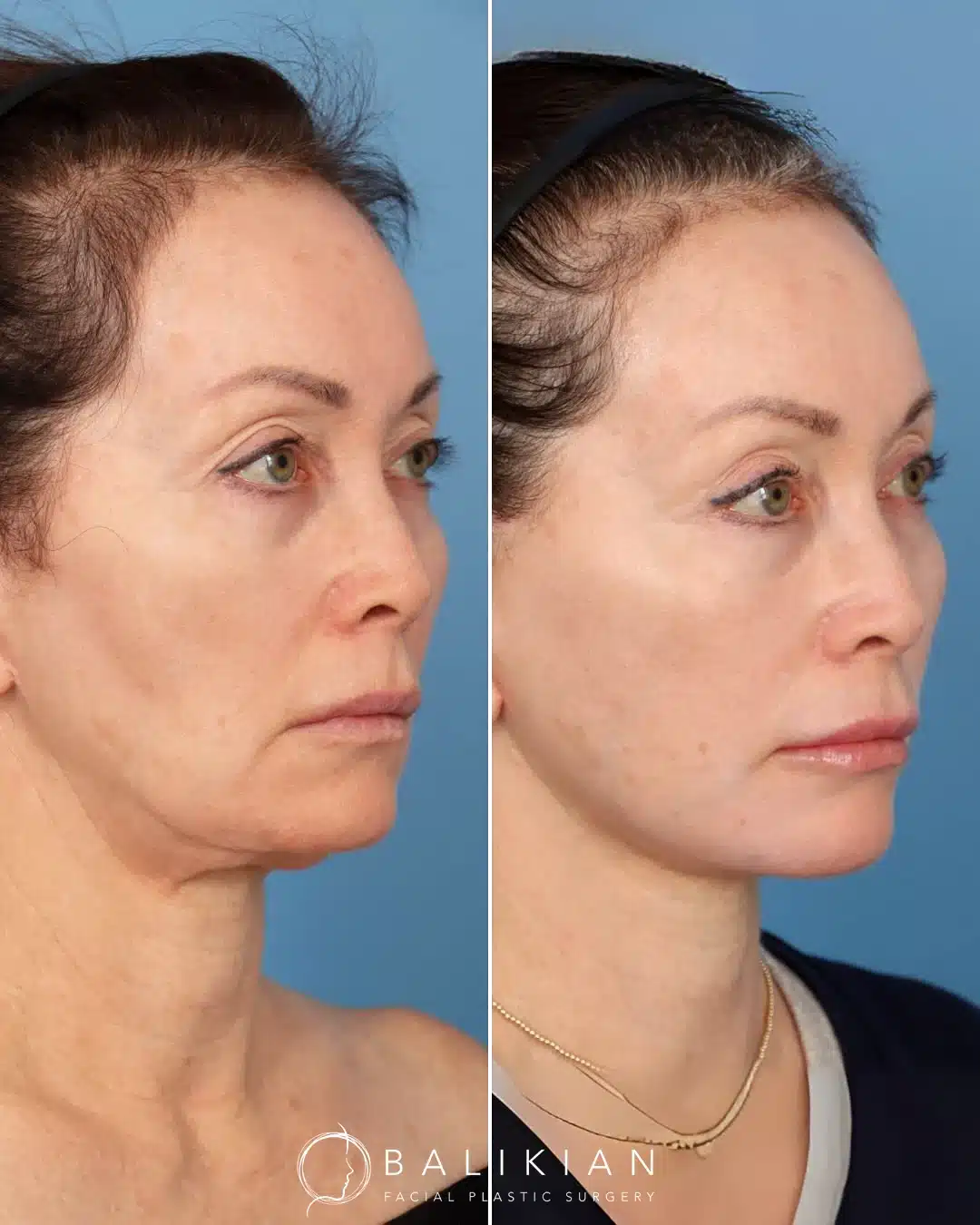 Three-quarter view before and after facelift and neck lift with lifted cheeks and more defined jawline.