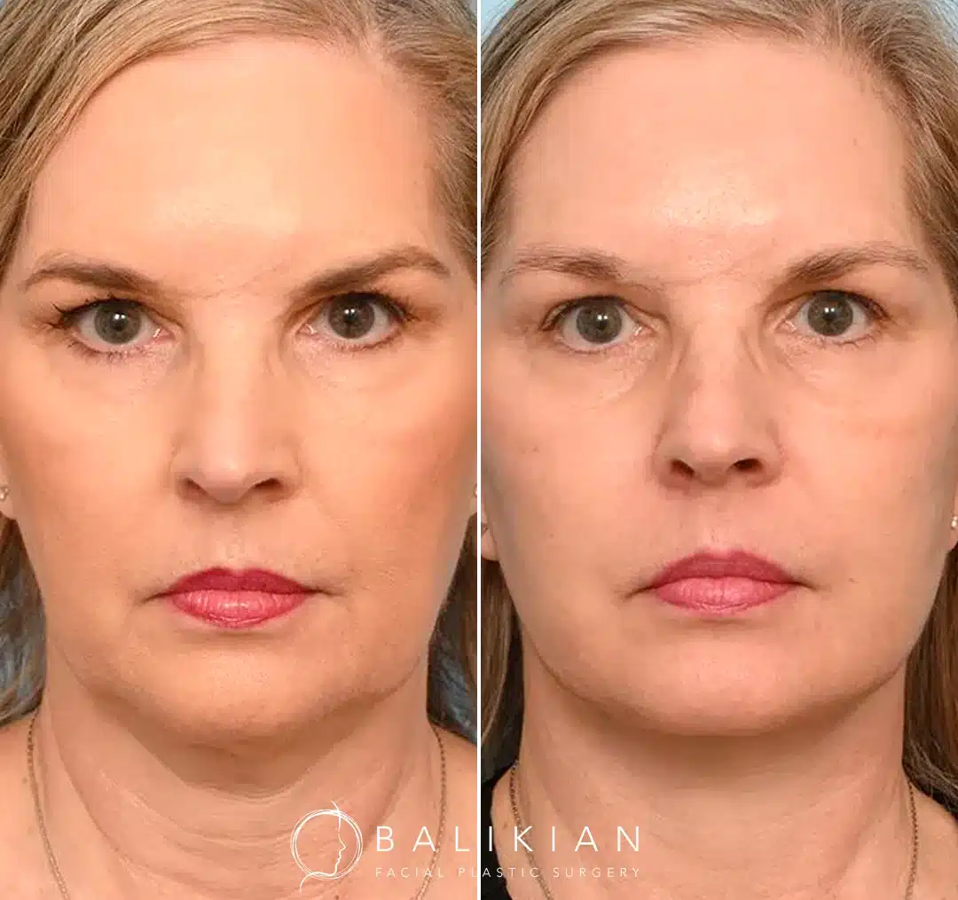 This patient in her late 50s wanted more contour and balance in her mid and lower face. Dr. Balikian performed the Artiste Lift™, his signature preservation deep plane face and neck lift, to achieve a natural, rejuvenated look.