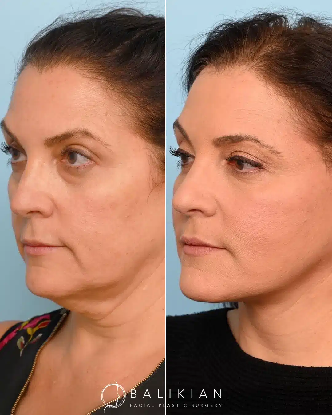 Facelift and neck lift before and after in San Diego showing improved jawline contour and smoother neckline with the Artiste Lift.