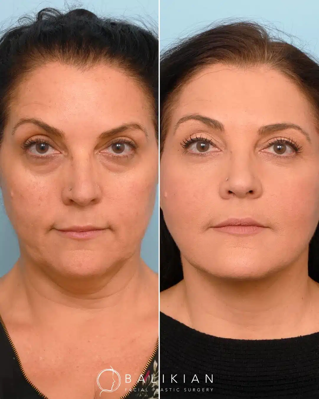 Artiste Lift before and after front view in San Diego highlighting lifted cheeks, refined neck, and a natural rejuvenated look.
