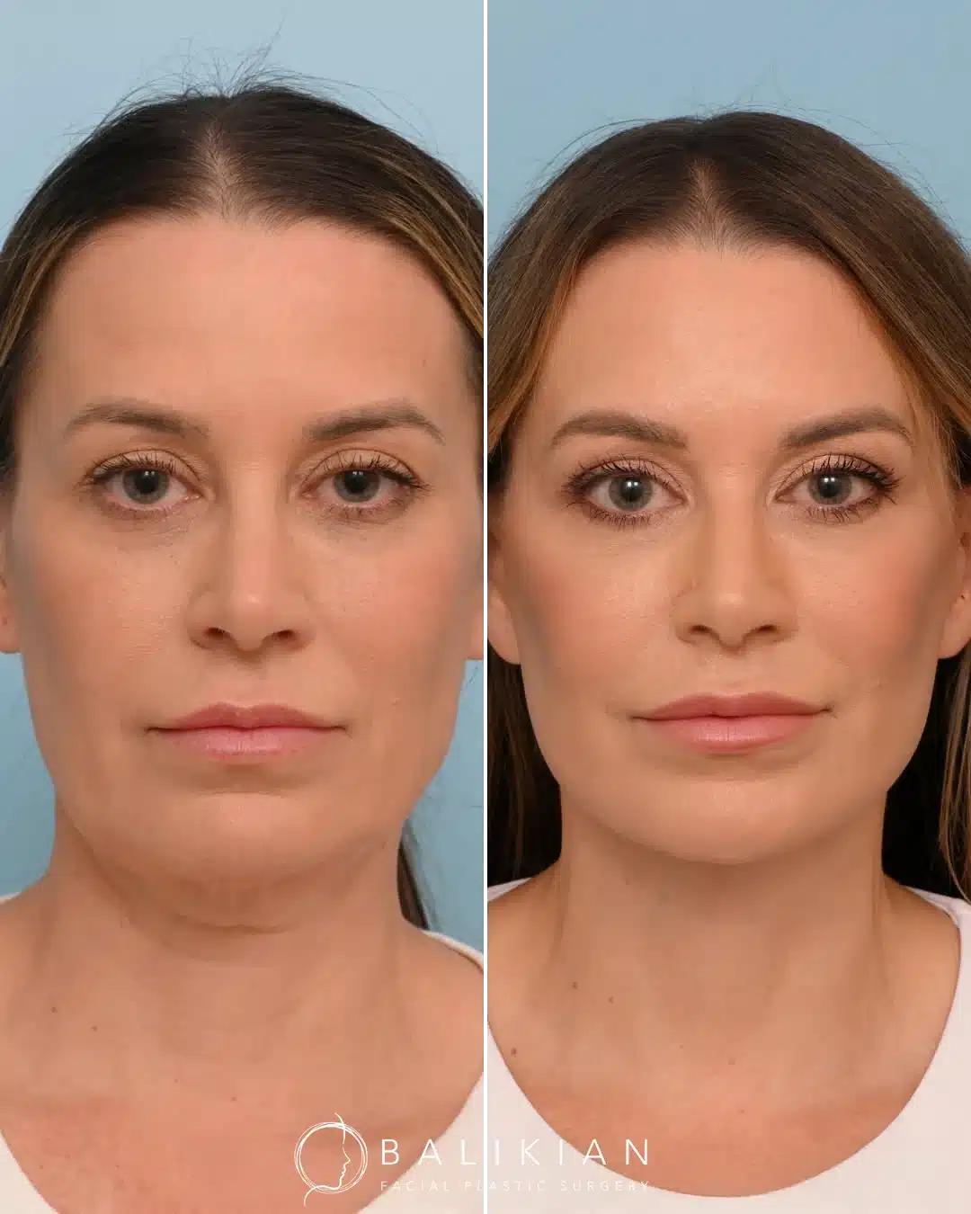 Front view before and after facelift and neck lift showing firmer jawline and smoother chin and neck.