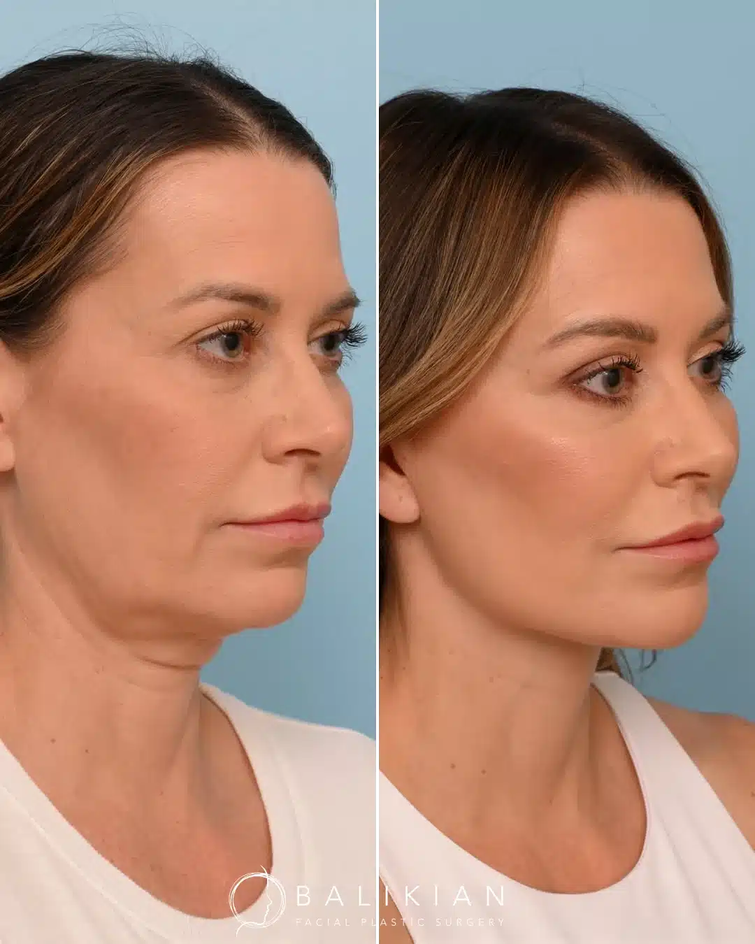 Three-quarter view before and after facelift and neck lift with refined neck contour and youthful profile.