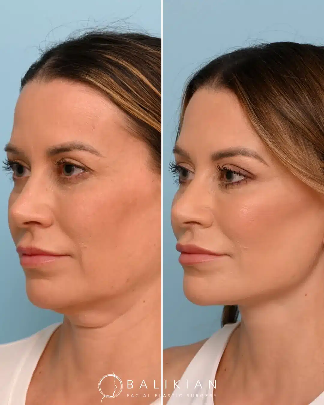 Three-quarter view before and after facelift and neck lift showing improved jawline definition.