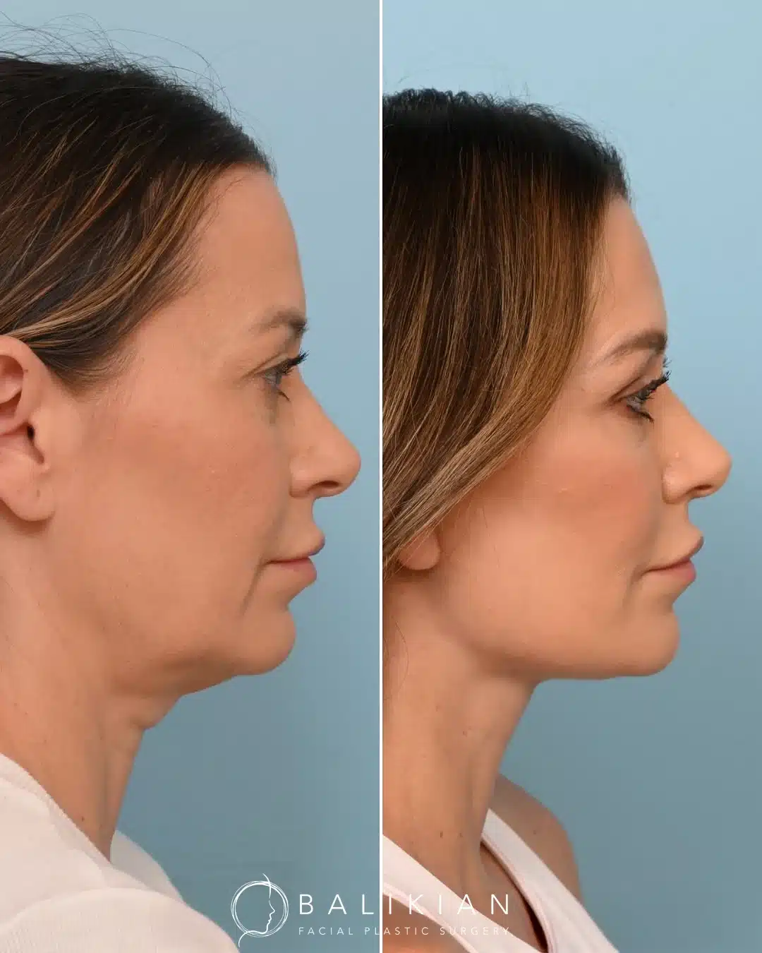 Profile view before and after facelift and neck lift highlighting tighter neck and sharper chin angle.