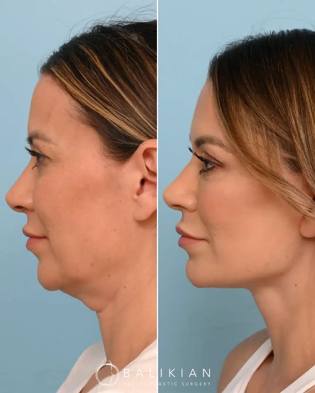 Profile view before and after facelift and neck lift showing smoother neckline and sculpted jawline.