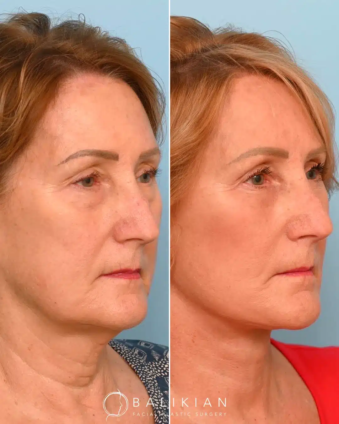 Artiste Lift preservation deep plane facelift before and after in San Diego with a tightened neckline and sculpted jawline.