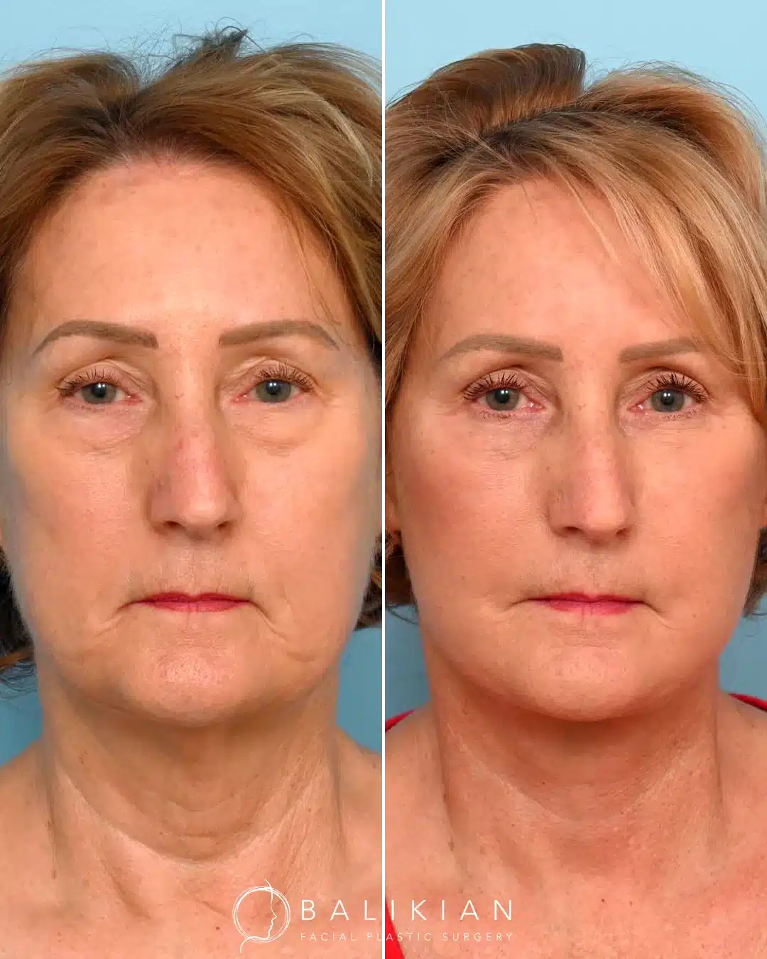 Facelift and neck lift before and after side view in San Diego showing reduced sagging, sharper profile, and restored balance.