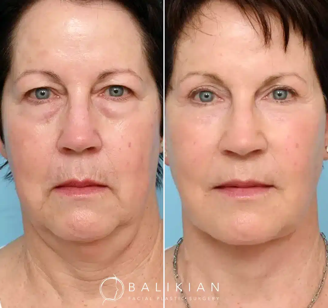 Front view before and after facelift and neck lift showing smoother neckline, reduced jowls, and natural facial rejuvenation.