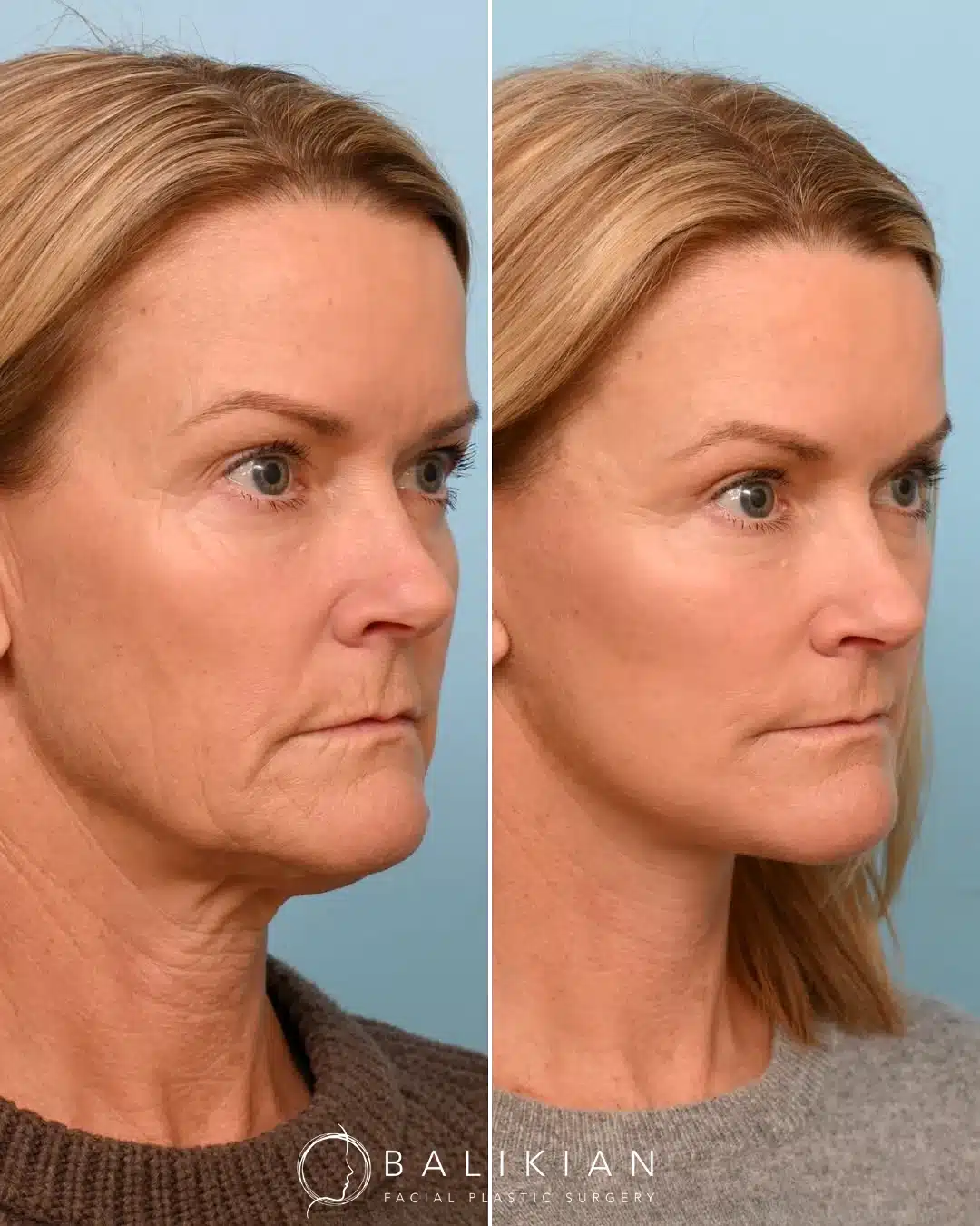 Three-quarter view before and after facelift and neck lift showing lifted lower face and smoother neck.