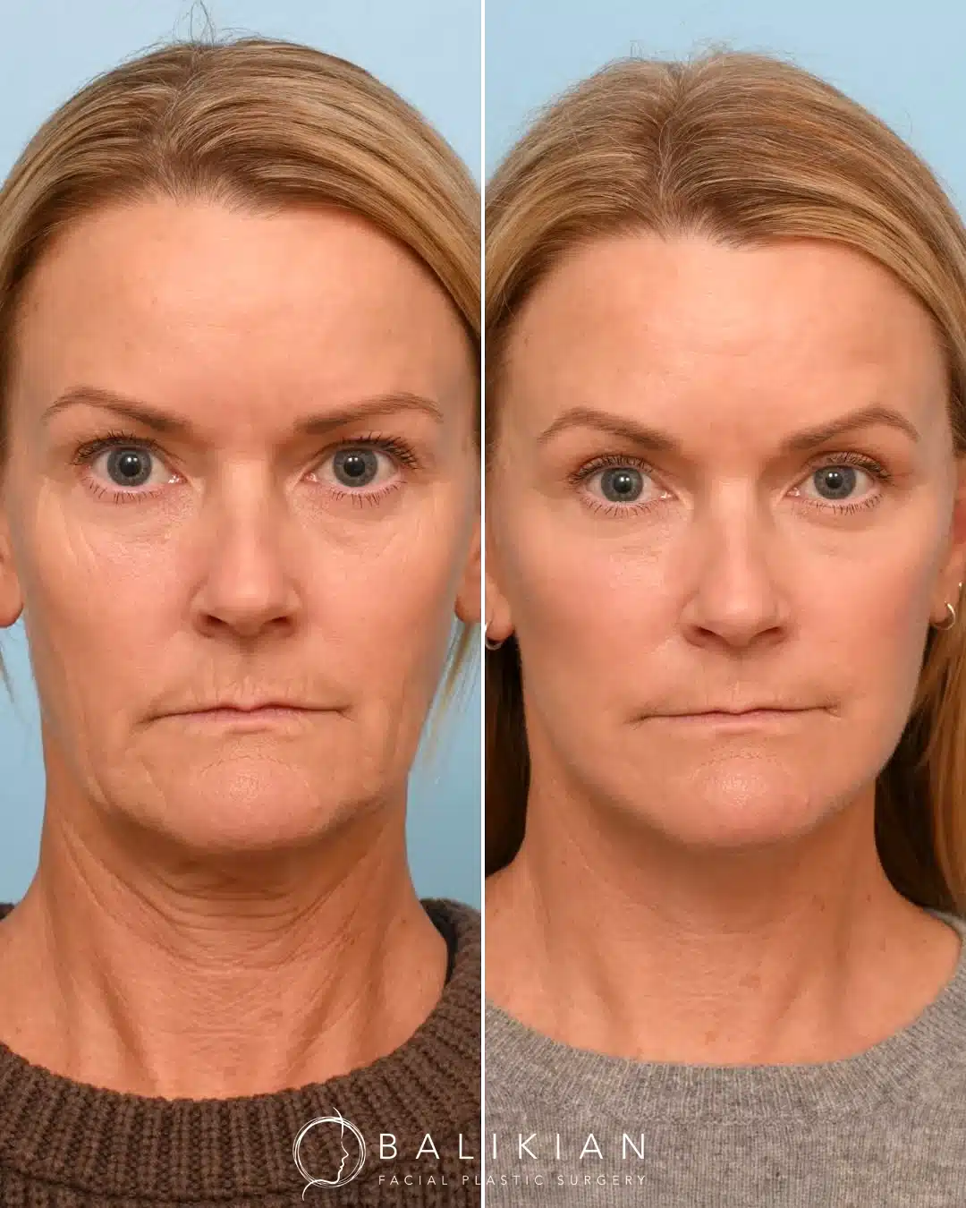 Front view before and after facelift and neck lift with tightened jawline and balanced facial contours.