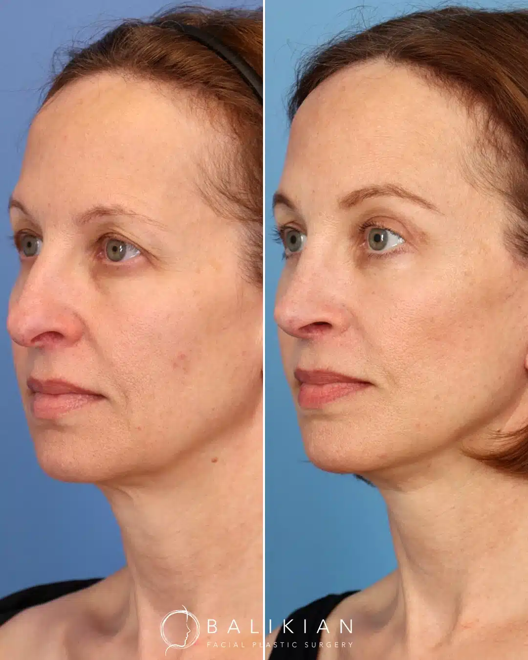 Before and after Artiste Lift deep plane facelift in San Diego showing softened folds, lifted midface, and natural contours.