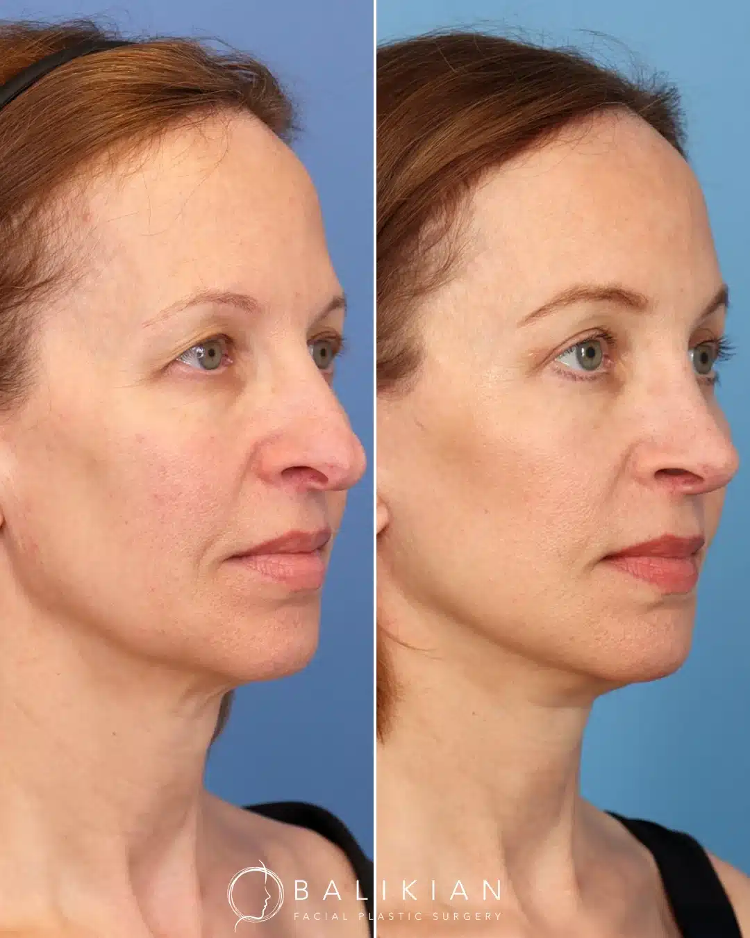 Artiste Lift before and after oblique view in San Diego with a refined neck, defined jawline, and refreshed expression.
