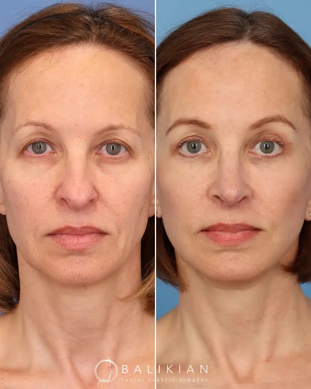 Facelift and neck lift before and after in San Diego highlighting improved skin tone and vertical neck lift results.