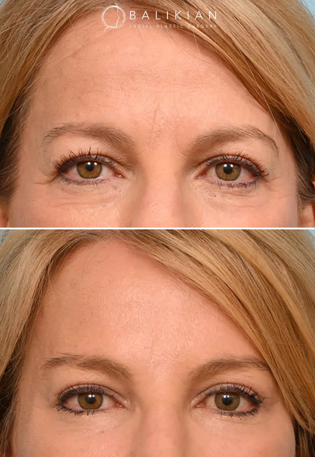 Before and after front view of a brow lift patient showing smoother forehead and lifted brows.