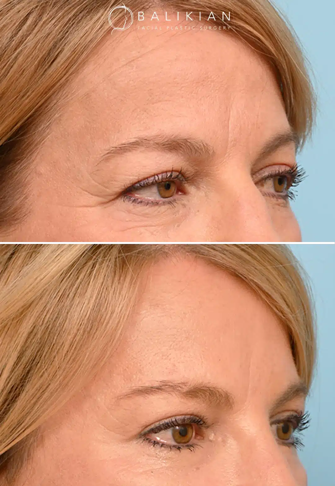 Before and after angled view of a brow lift patient with elevated brows and refreshed eye area.