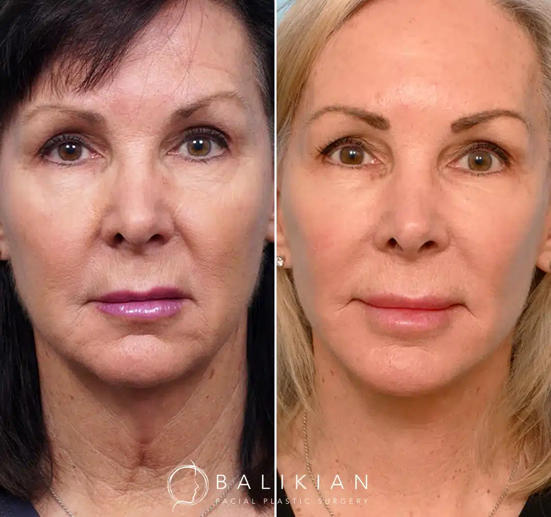 Front view before and after deep plane facelift and neck lift showing smoother jawline, lifted midface, and refreshed overall appearance.