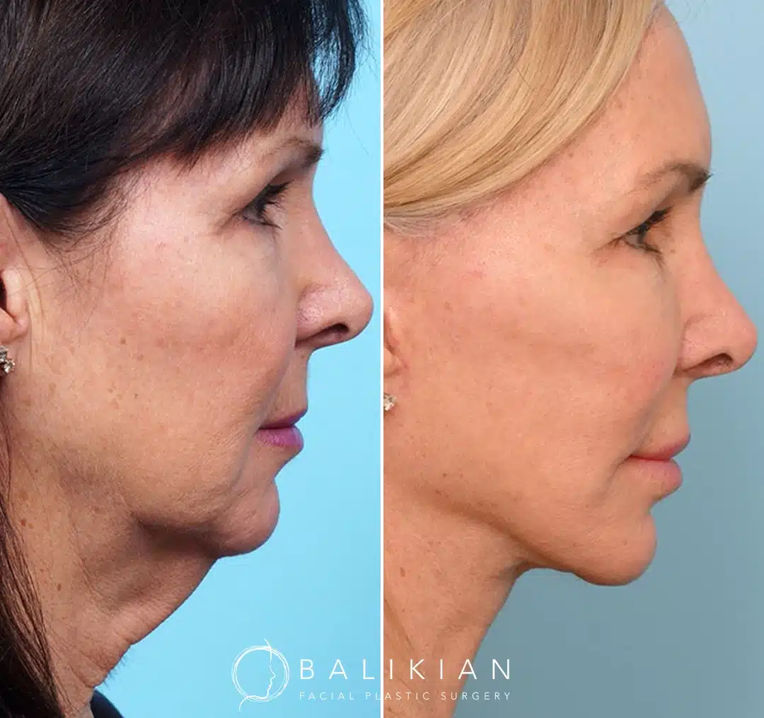 Profile view before and after deep plane facelift and neck lift demonstrating improved neck contour, reduced sagging, and natural rejuvenation.