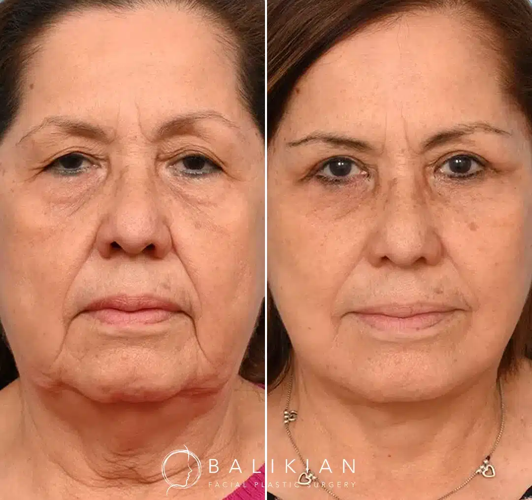 Before and after photos of a woman with dark hair showing facelift results.