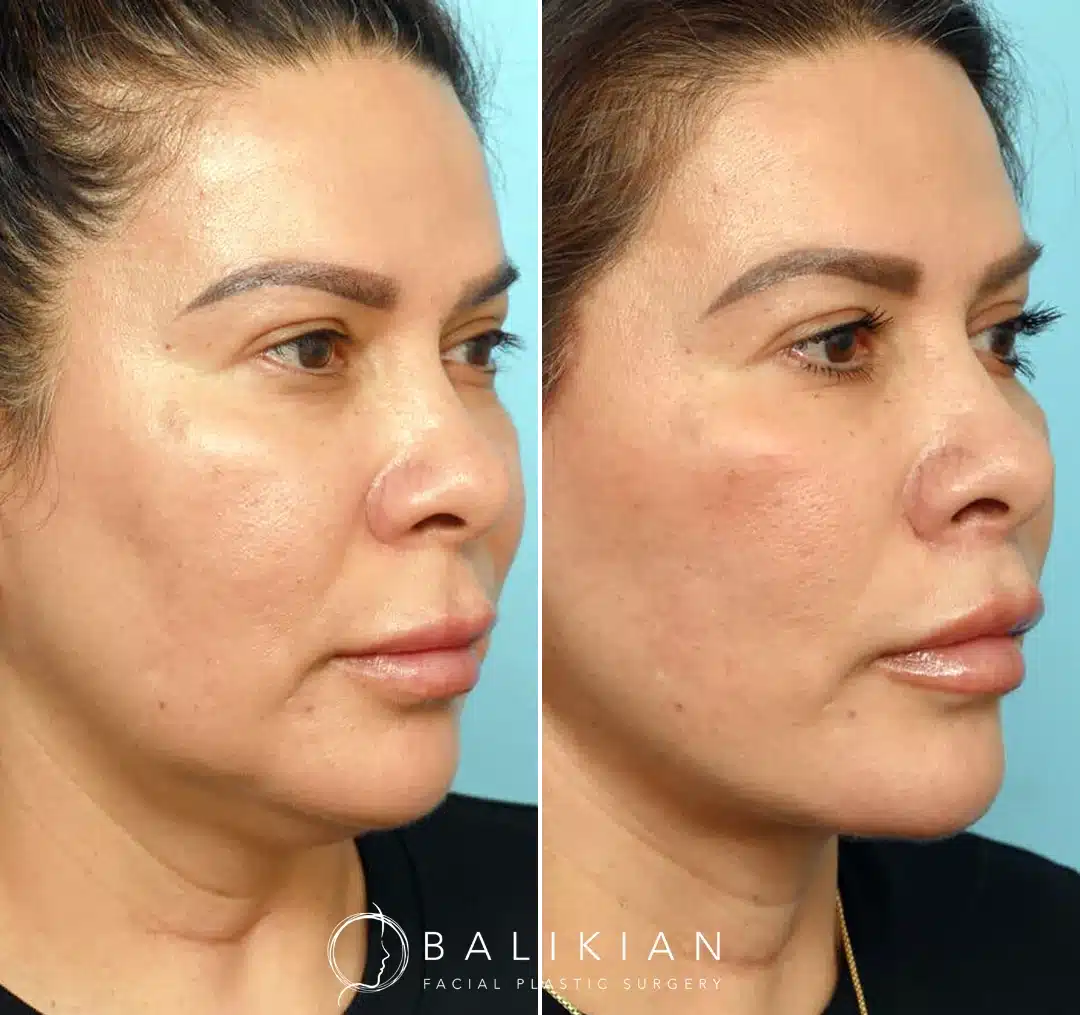 Three-quarter view before and after deep plane facelift showing lifted midface, firmer jawline, and smoother skin texture.