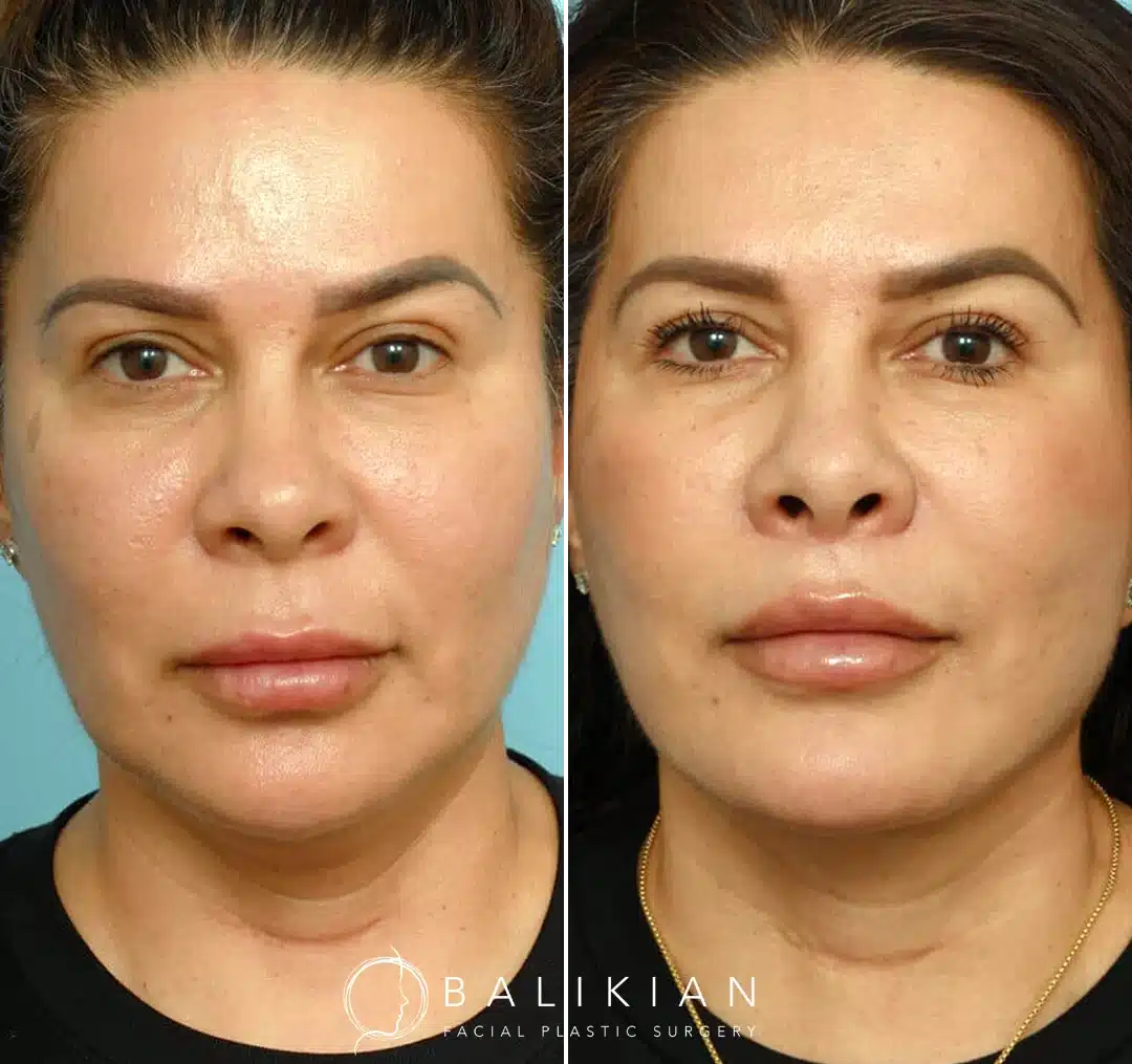 Front view before and after deep plane facelift highlighting reduced jowls, defined lower face, and refreshed youthful look.