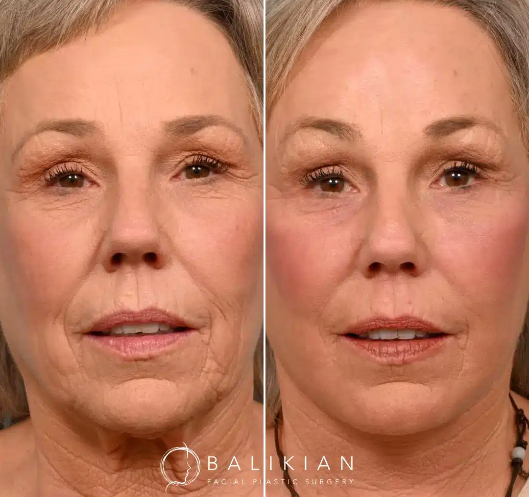 A close-up frontal view of a woman before and after a facelift, highlighting reduced wrinkles, fuller cheeks, and a refreshed overall appearance.