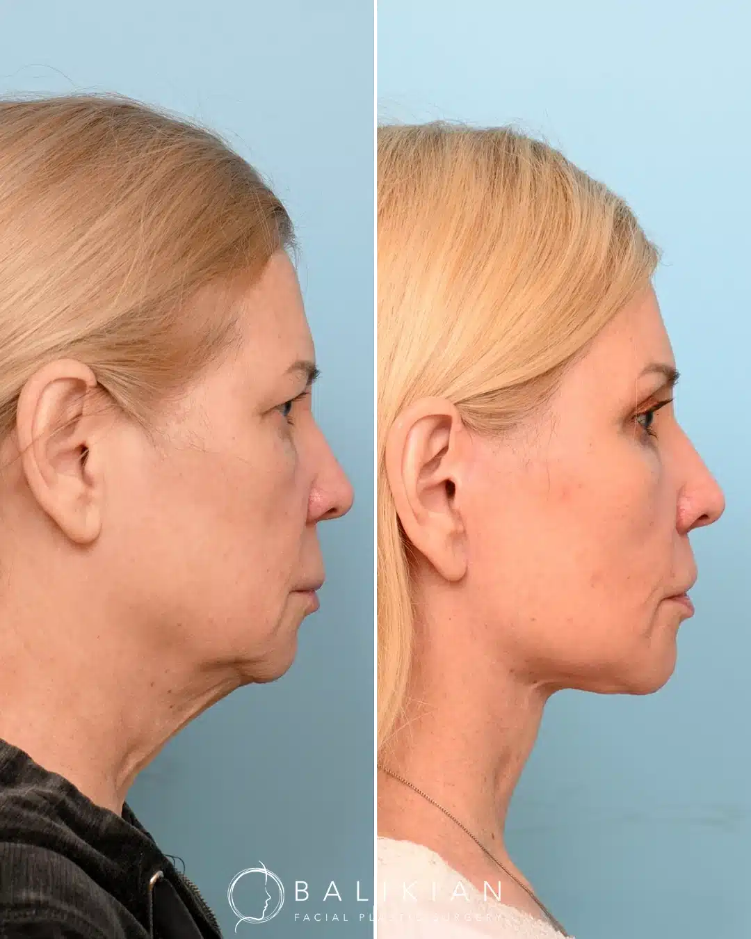 Artiste Lift before and after front view in San Diego with balanced facial rejuvenation and a natural refreshed appearance.