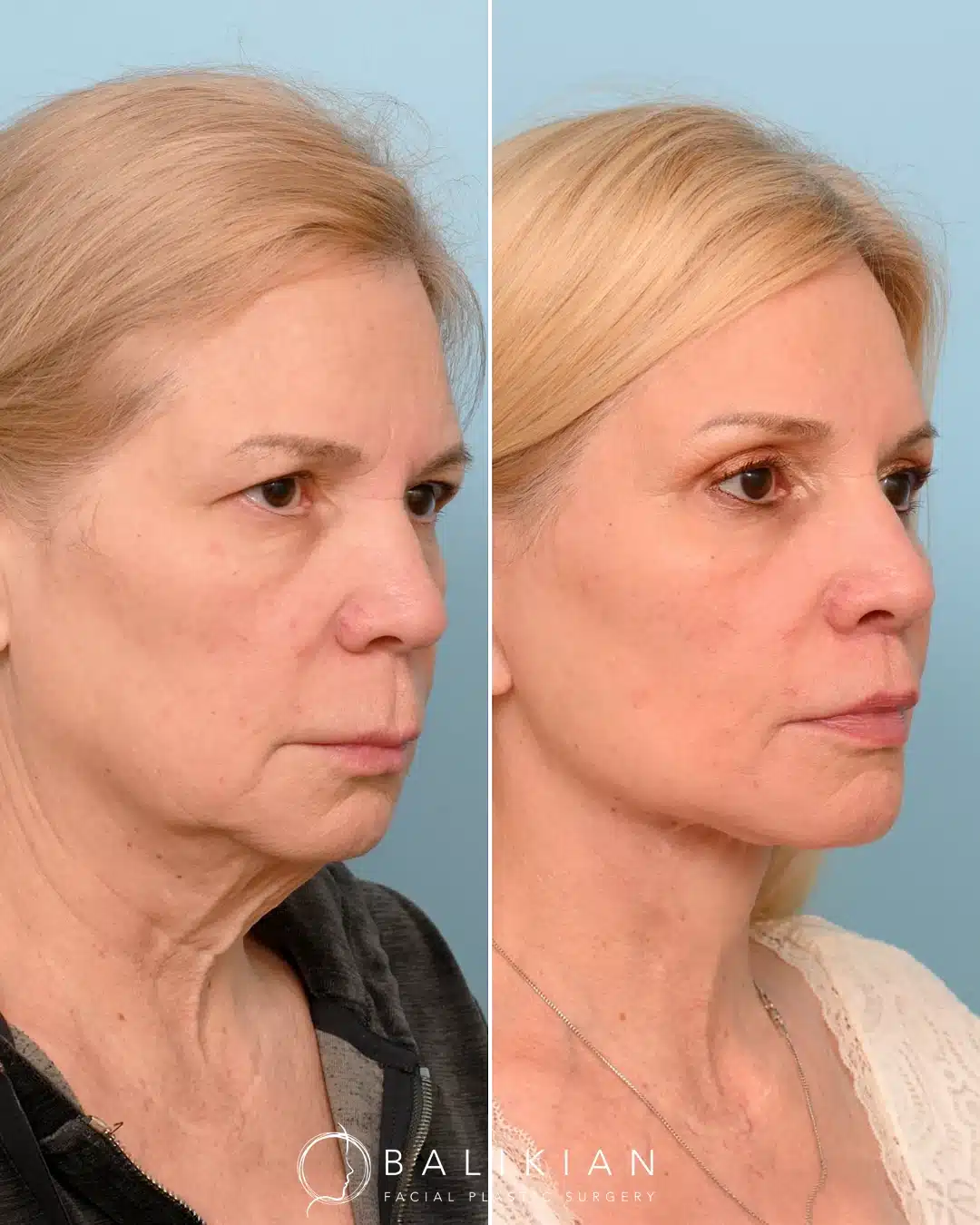 Facelift and neck lift before and after in San Diego highlighting a smoother neckline, lifted cheeks, and harmonious results.