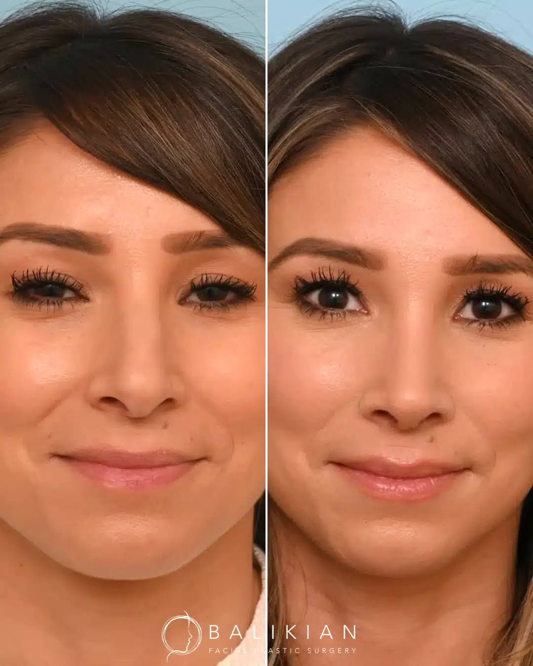 Before and after rhinoplasty, frontal view, one month post-op: refined nasal tip and bridge with improved symmetry.