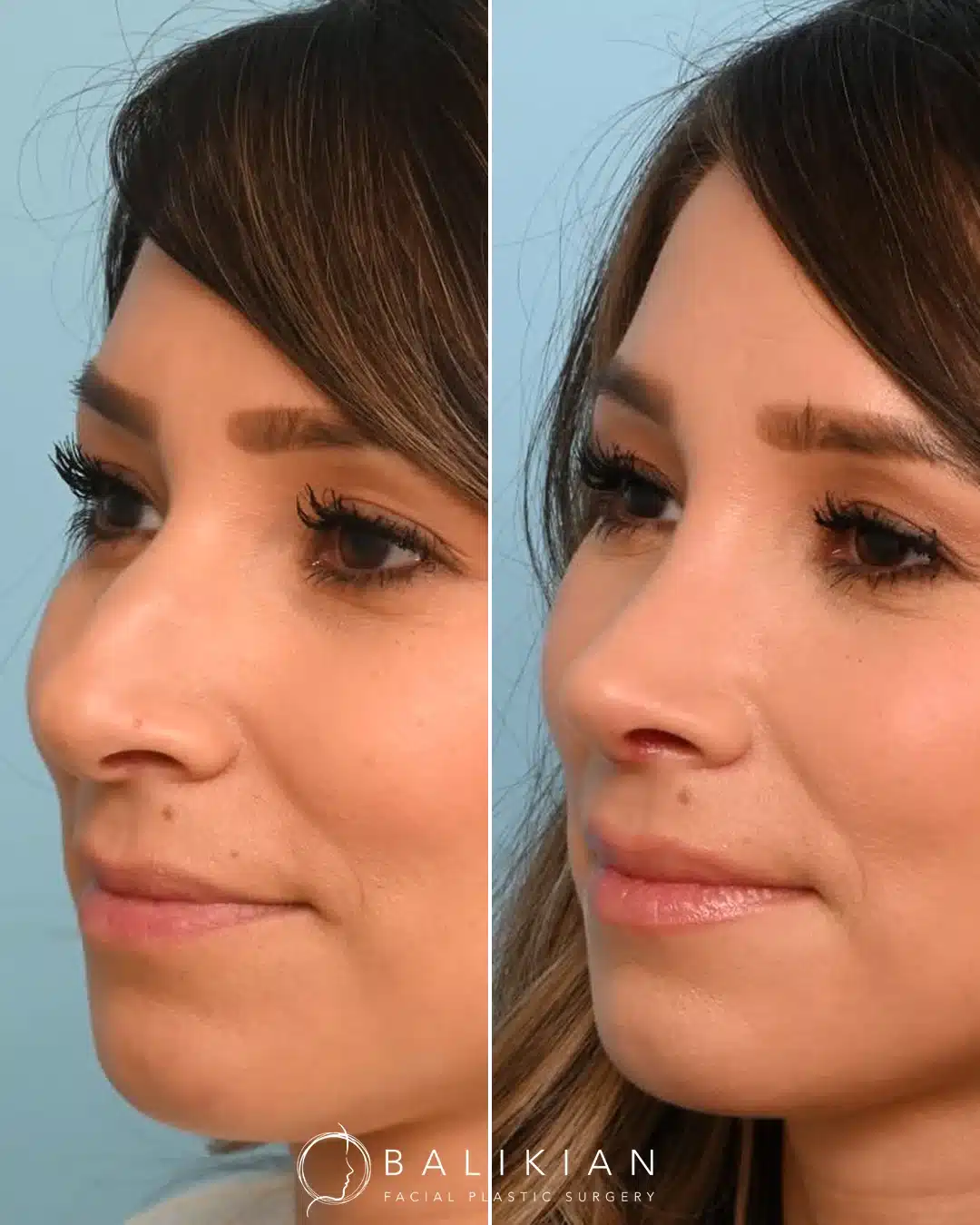 Before and after rhinoplasty, left oblique, one month post-op: reduced dorsal hump and smoother bridge.