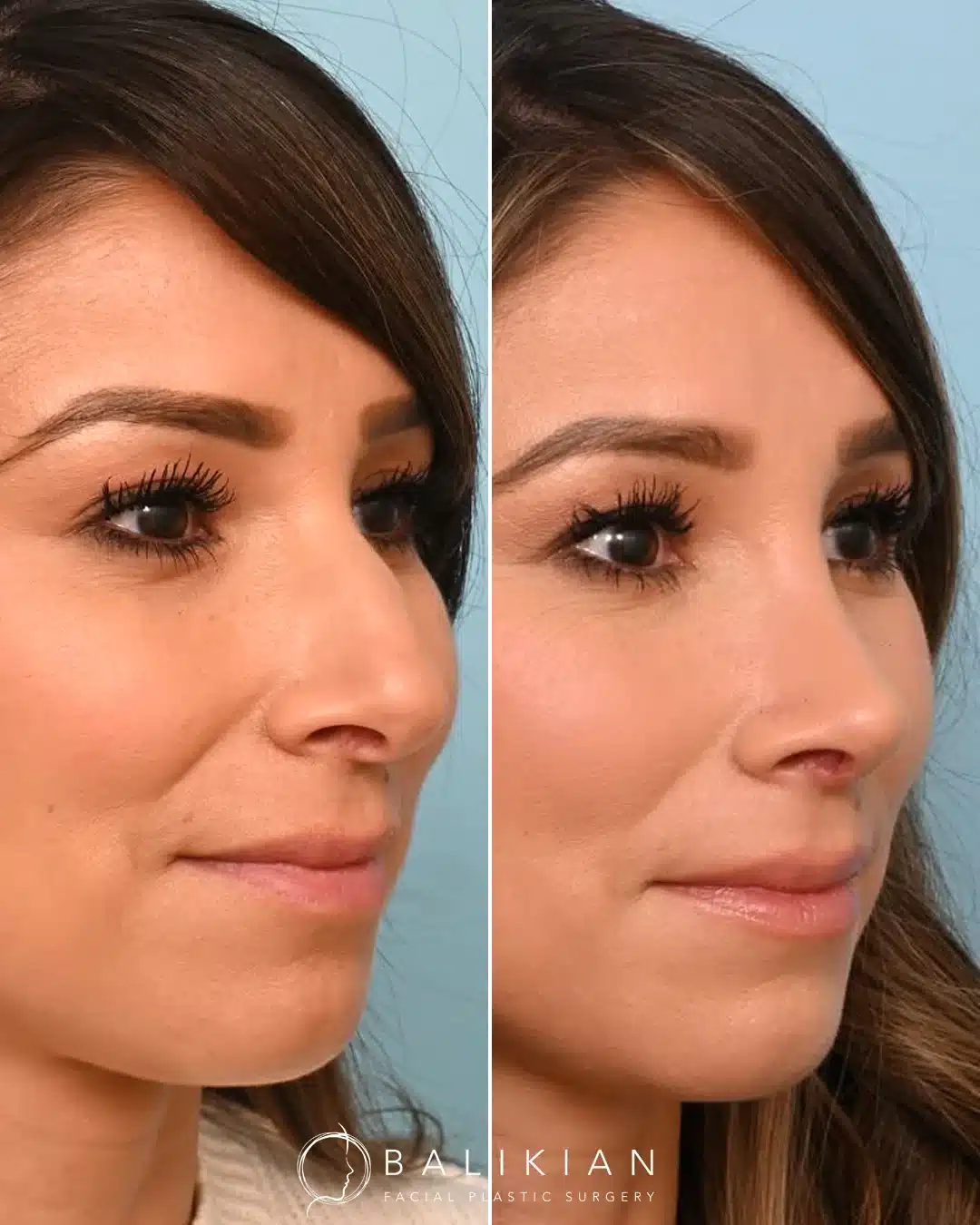Before and after rhinoplasty, right oblique, one month post-op: straighter bridge with subtle tip refinement.
