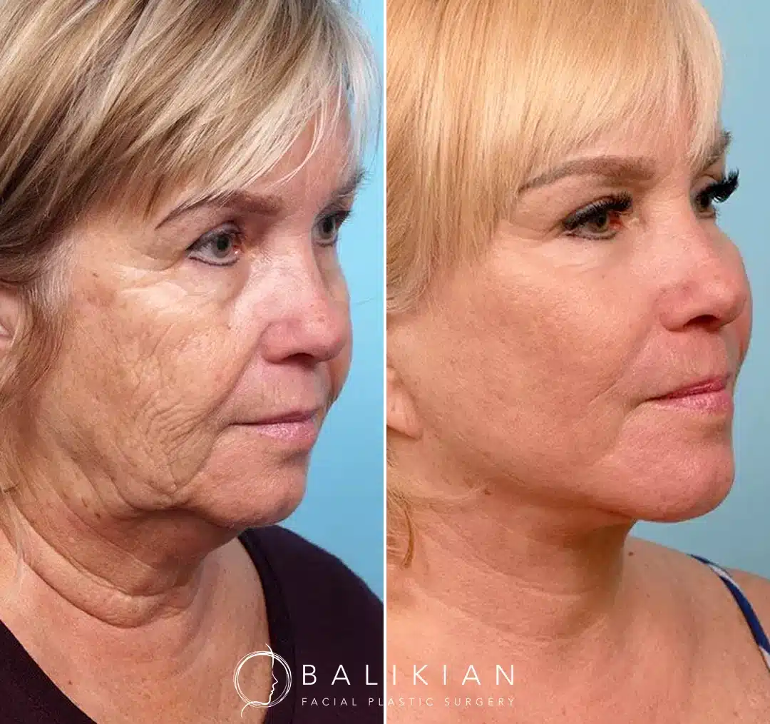 Angled view of a woman before and after a facelift, showing significant improvement in skin texture, facial contour, and neck definition.