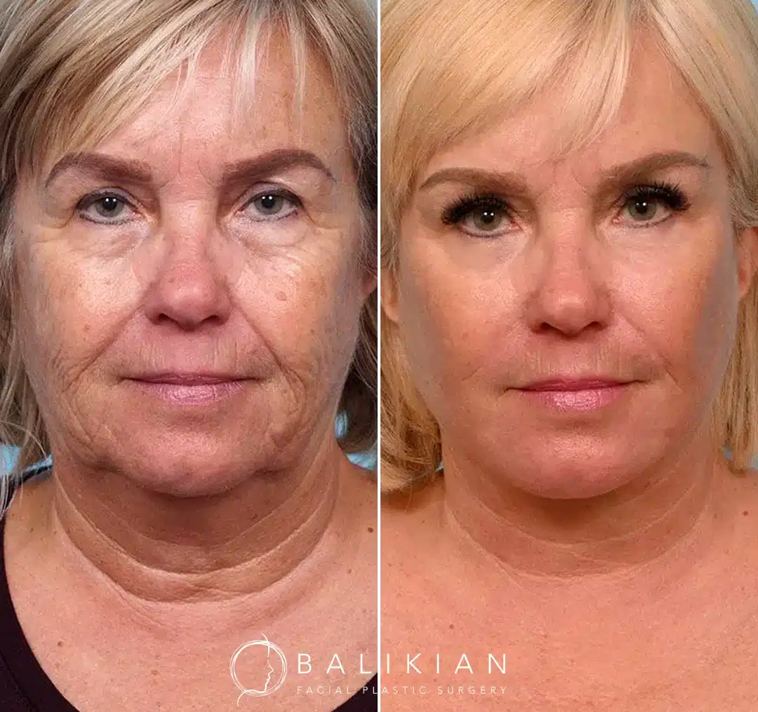 Frontal before-and-after images of a woman following a facelift and neck lift, with noticeable tightening along the jawline and neck, and smoother facial skin.
