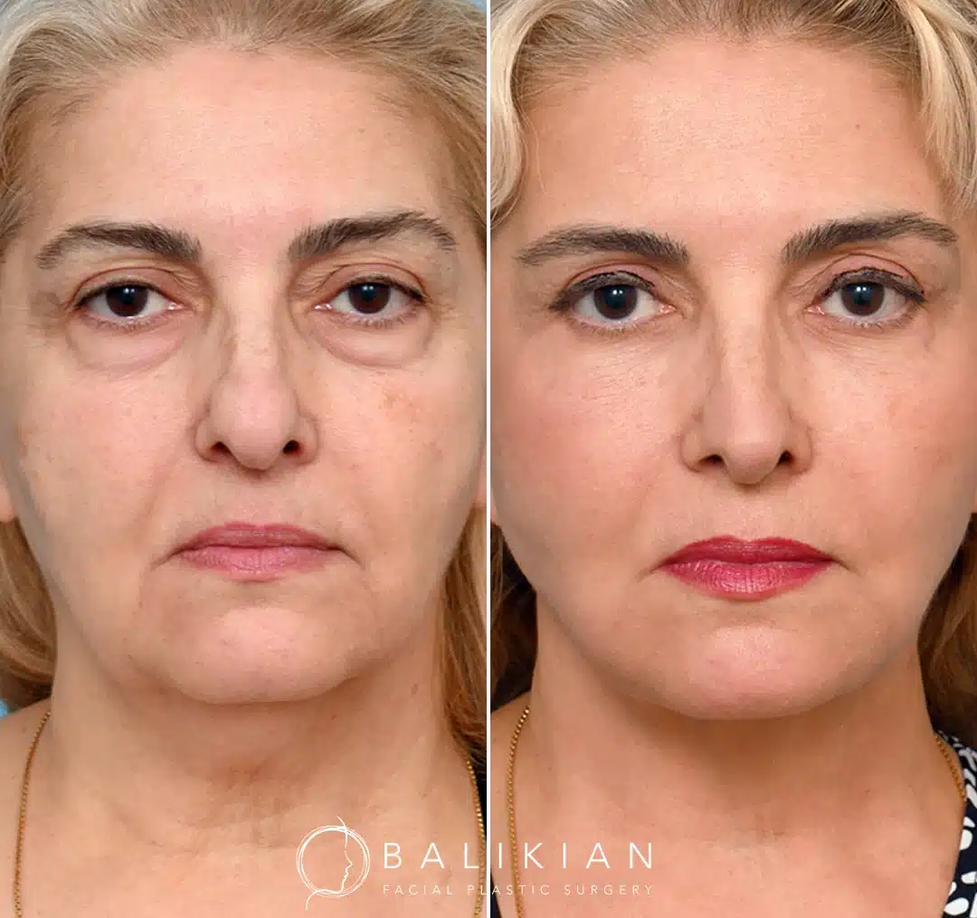 Front view before and after deep plane facelift in San Diego showing improved facial balance, reduced sagging, and natural lift.