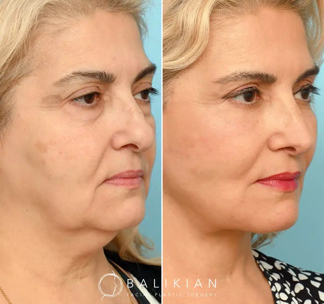 Side view before and after deep plane facelift demonstrating improved neck contour, defined jawline, and rejuvenated lower face.