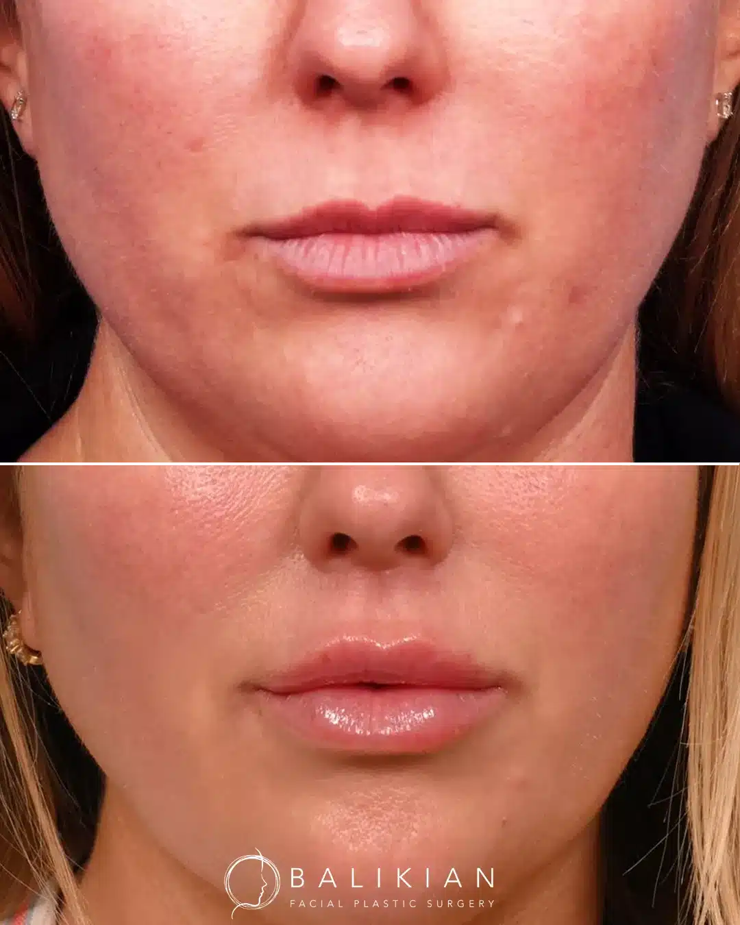 Before and after frontal view of a female patient who received a surgical lip lift with Dr. Richard Balikian, showing a shortened distance between the nose and upper lip, enhanced lip volume, and improved definition for a balanced, youthful appearance.