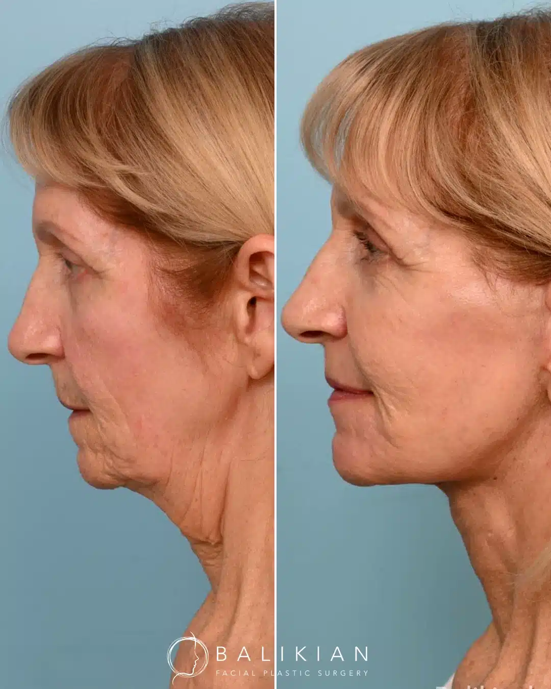 Facelift and neck lift before and after side profile in San Diego showing smoother neckline, reduced sagging, and natural rejuvenation with the Artiste Lift.