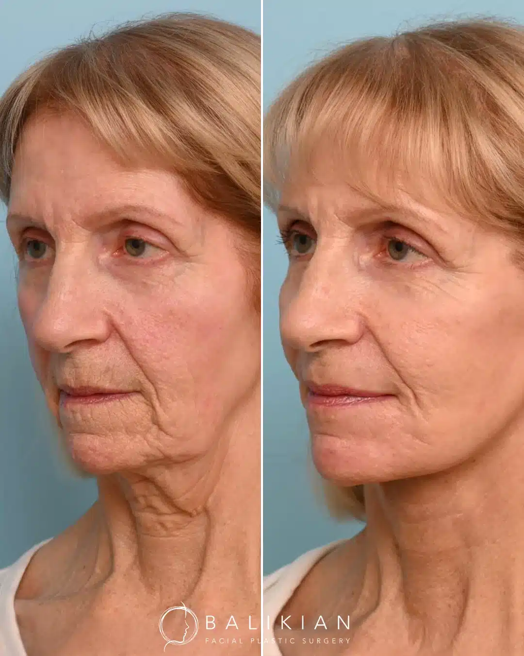 Artiste Lift before and after oblique view in San Diego highlighting lifted cheeks, softened wrinkles, and a tighter jawline.