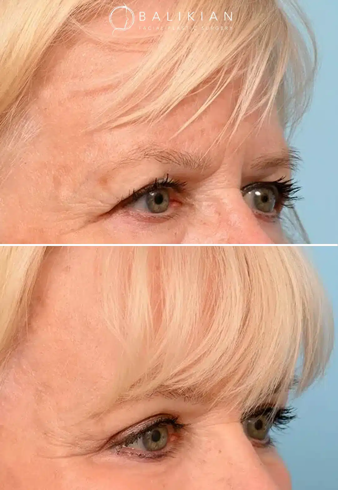 Brow lift before and after showing an angled view of a blonde-haired patient’s eyes and forehead with lifted brows, smoother skin texture, and a rejuvenated expression after surgery
