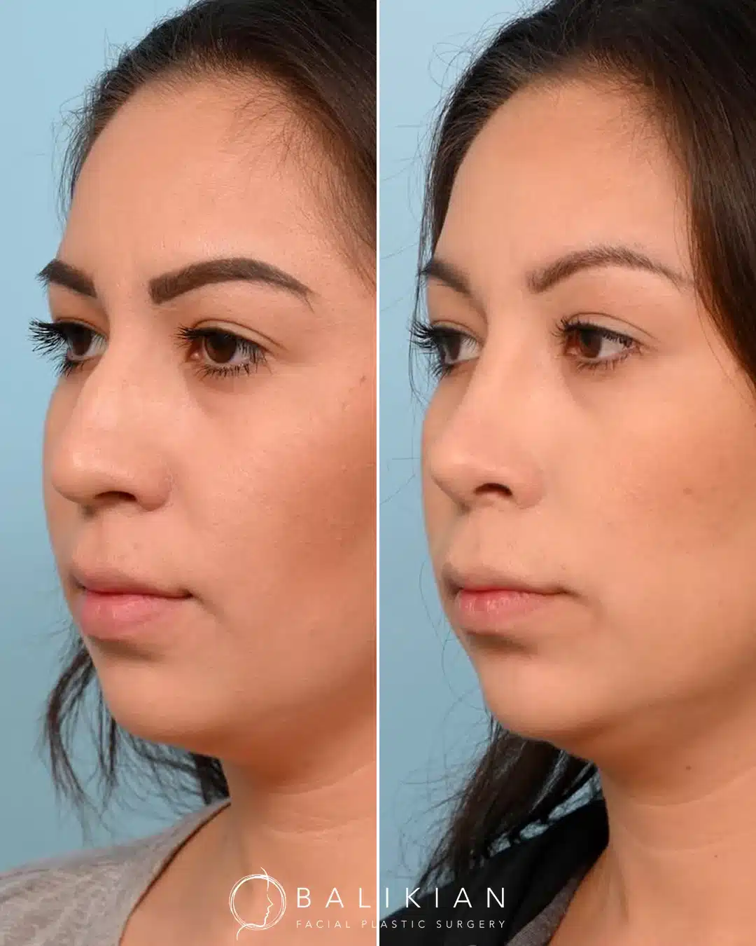 Before and after rhinoplasty, left oblique view: balanced profile with slimmer bridge and tip.