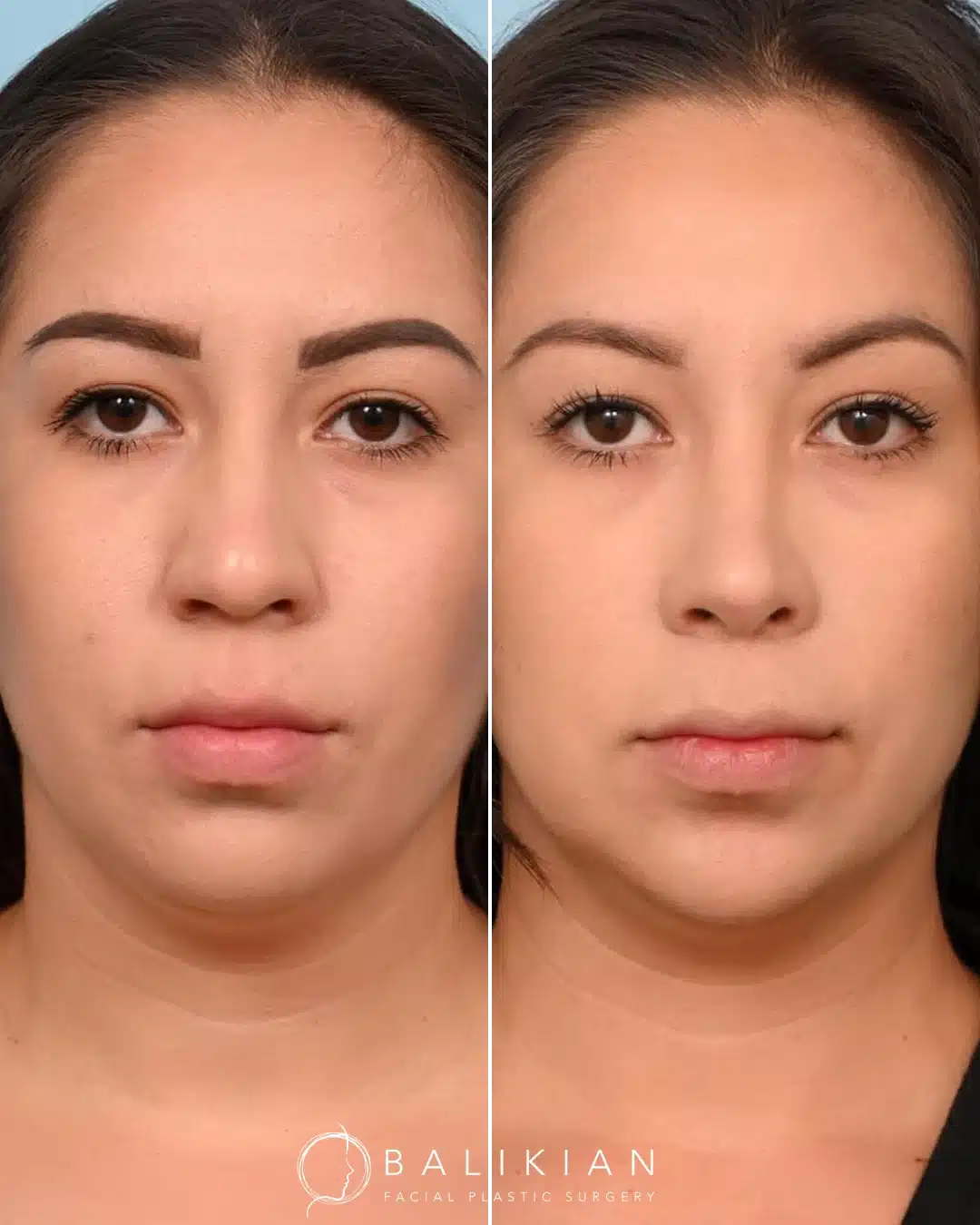 Before and after rhinoplasty, frontal view: softened tip and narrowed nasal width for facial balance.