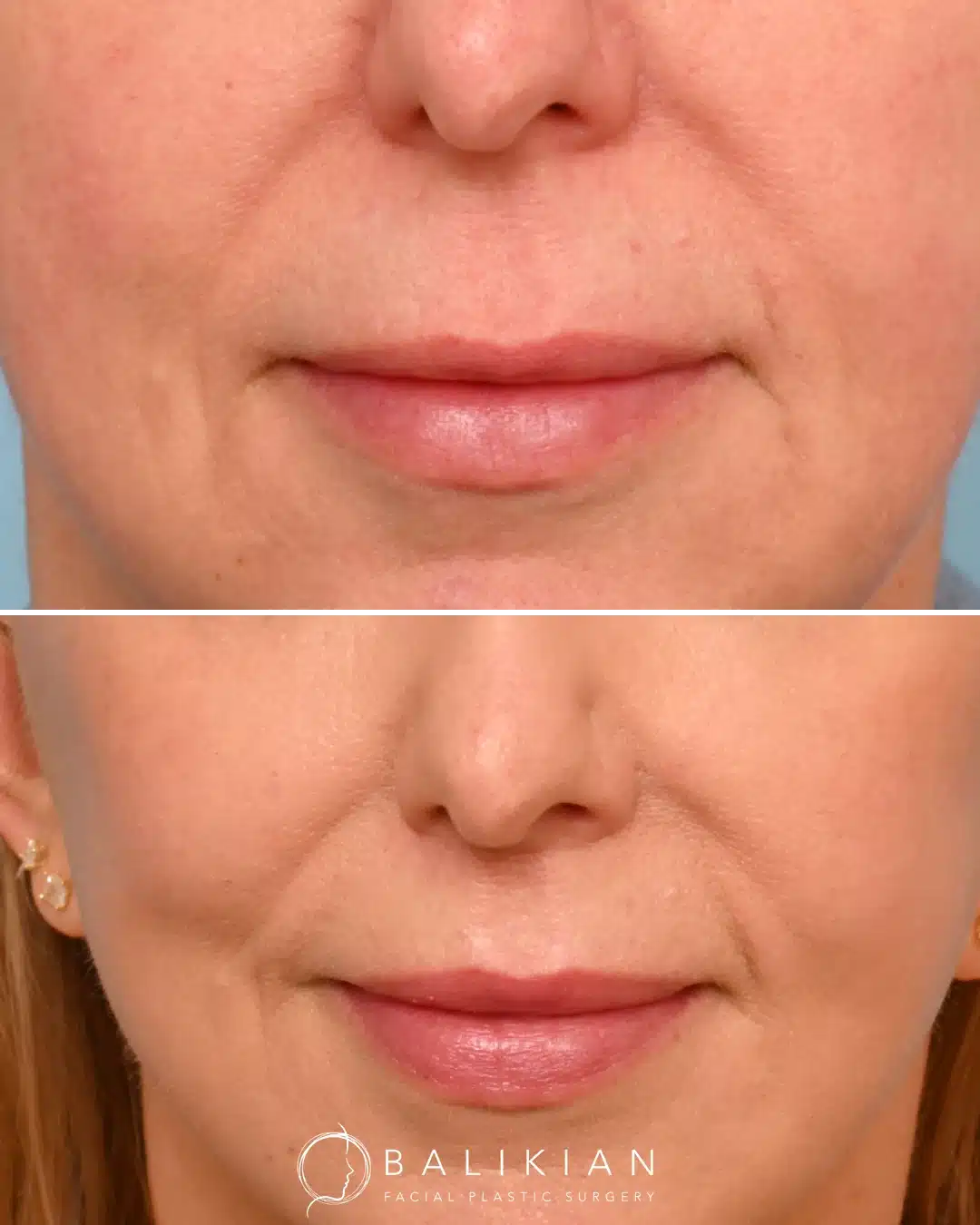 Close-up angled view of a woman’s lips before and after subnasal lip lift surgery with Dr. Richard Balikian, showing increased upper lip height, enhanced lip shape, and natural-looking volume