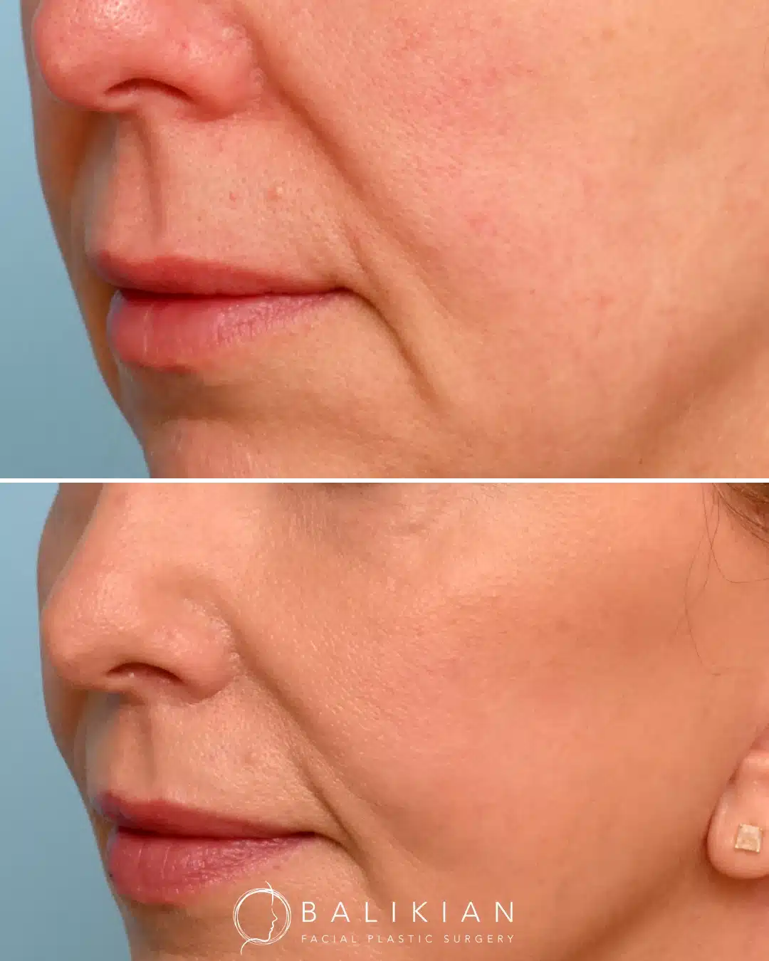Front-facing view of a woman’s lips before and after subnasal lip lift surgery with Dr. Richard Balikian, revealing a lifted upper lip, improved balance between lips, and a youthful, defined smile