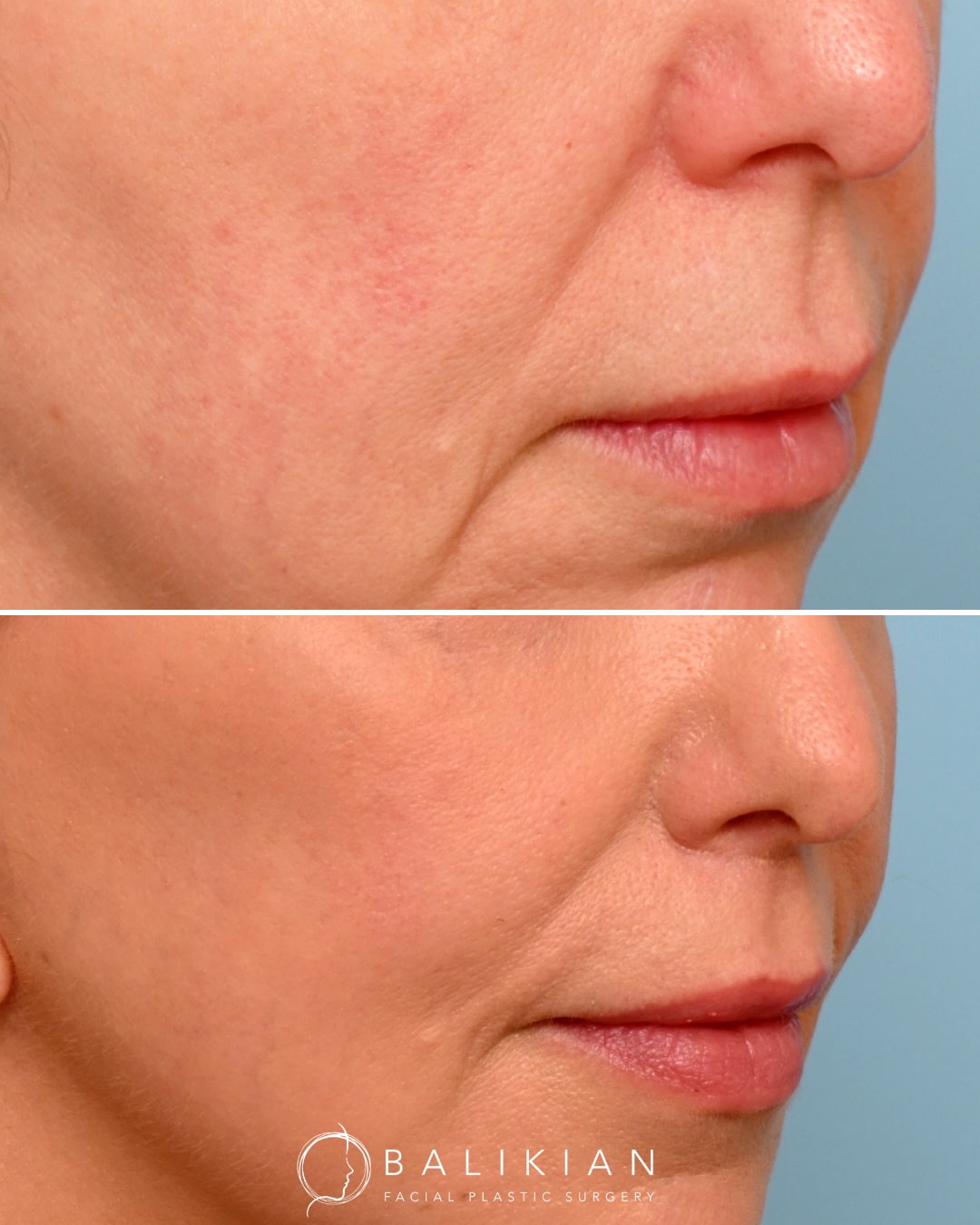 Close-up angled view of a woman’s lips before and after subnasal lip lift surgery with Dr. Richard Balikian, showing a shorter philtrum, lifted upper lip, and enhanced lip contour