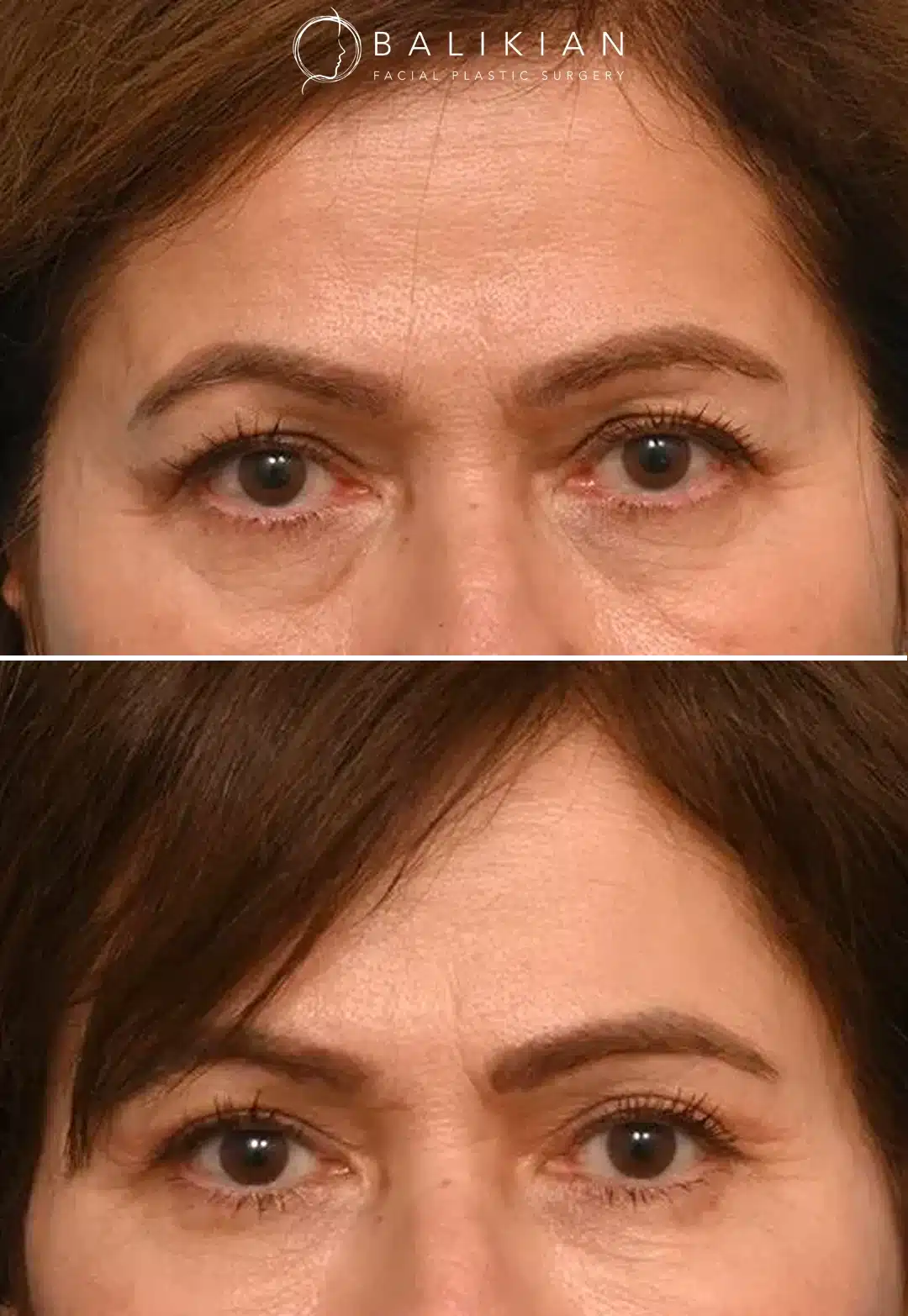 Before and after of a female patient after upper blepharoplasty and 4-point brow lift, showing lifted brows and smoother eyelids.