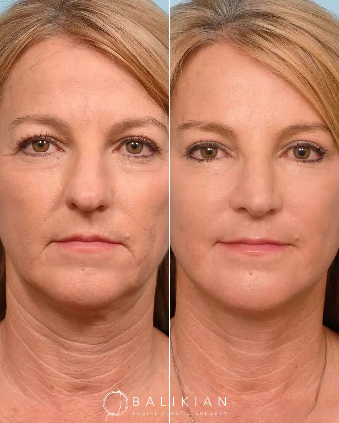 Facelift and neck lift before and after front view in San Diego showing refined jawline, smoother skin, and restored balance with the Artiste Lift.
