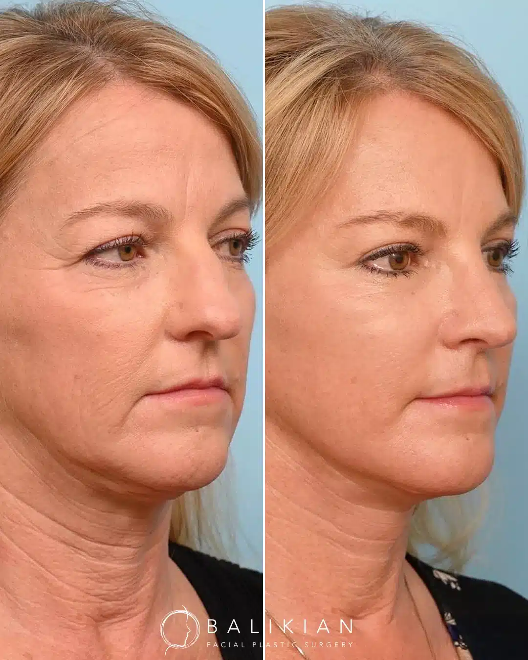 Artiste Lift before and after oblique view in San Diego with improved midface lift, defined neck contour, and youthful appearance.