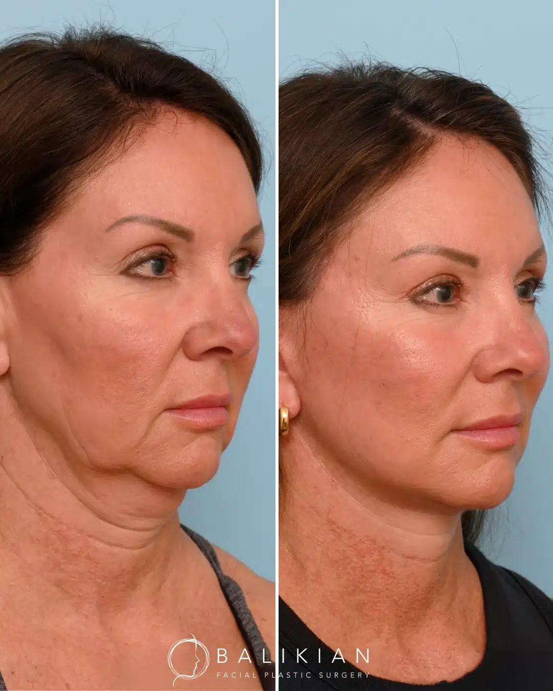 Facelift and neck lift before and after with tighter neckline and lifted lower face.
