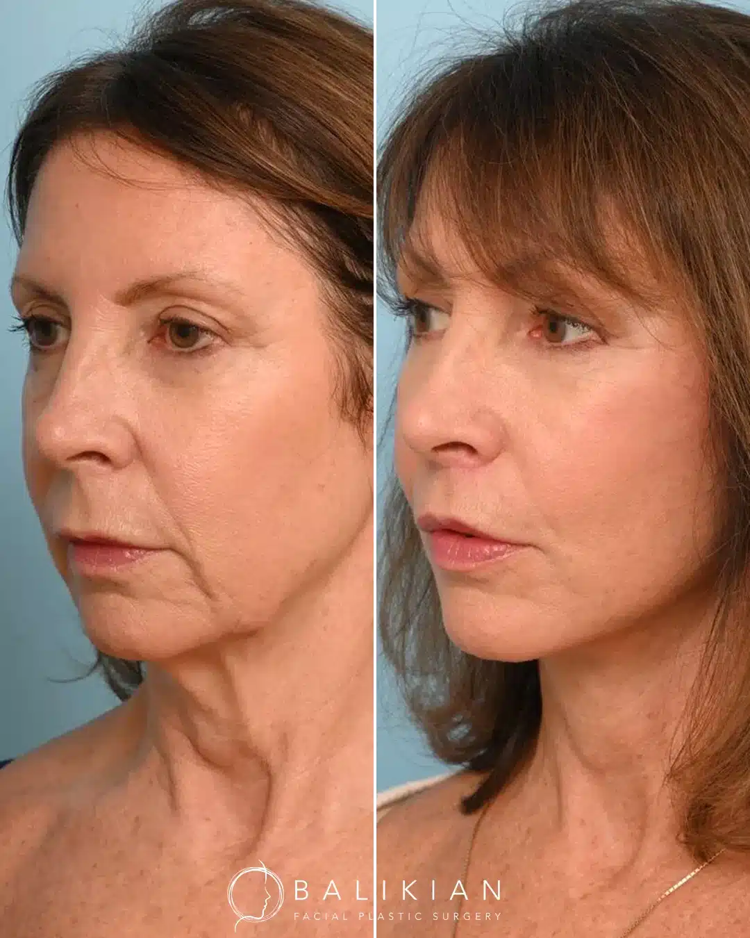 Angled before and after comparison of a deep plane facelift patient, highlighting lifted midface contours, tightened neck, and rejuvenated skin texture.