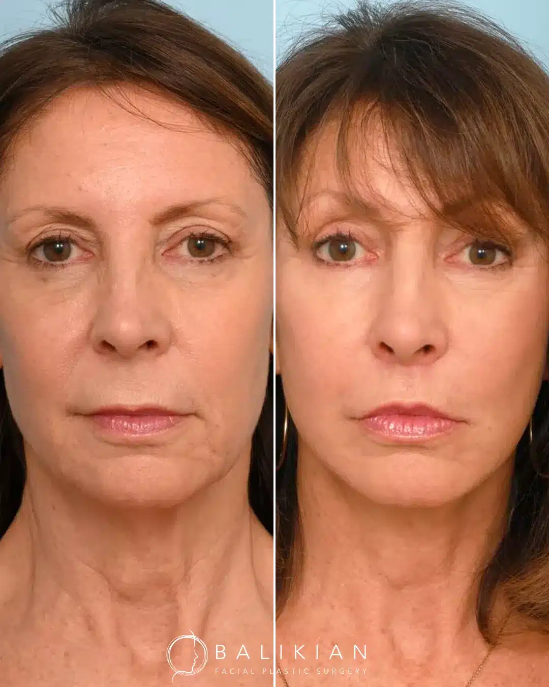 Front-facing before and after view of a deep plane facelift, showing a more defined jawline, reduced sagging in the lower face, and an overall refreshed appearance.